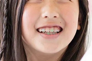 子どもの矯正治療